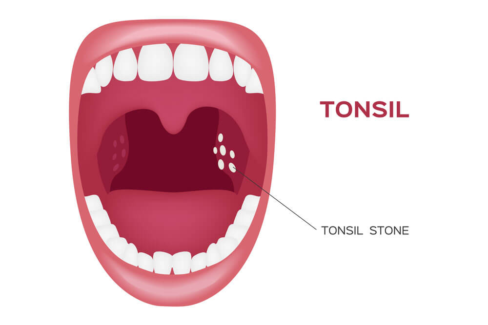 Tonsil Stones | ENT Consultants